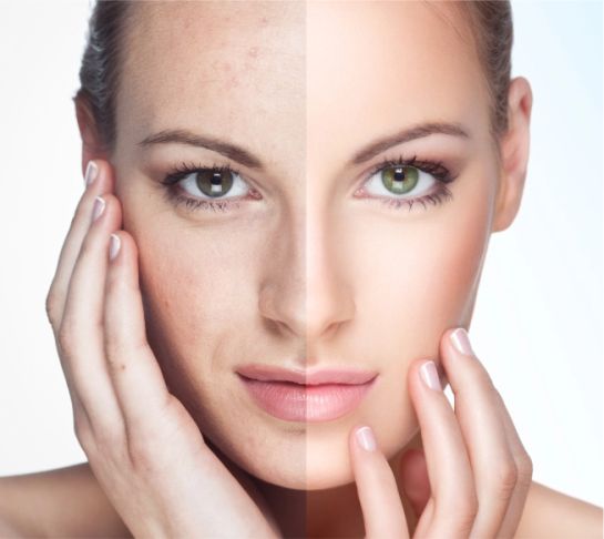 Before After MP Aesthetics Non Surgical Facial Treatments Newton Abbot