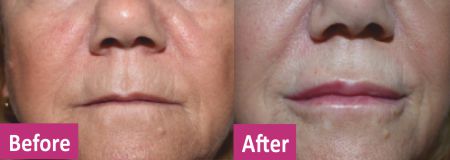 Dermal Fillers Before and After in Newton Abbot