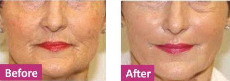 Platelet Rich Plasma before after