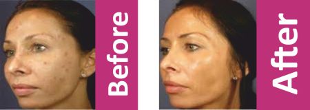 Platelet Rich Plasma before after In Newton Abbot