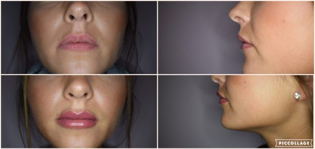 Lip Fillers