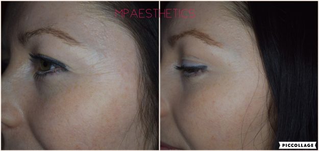 Anti Wrinkles Injections South Devon