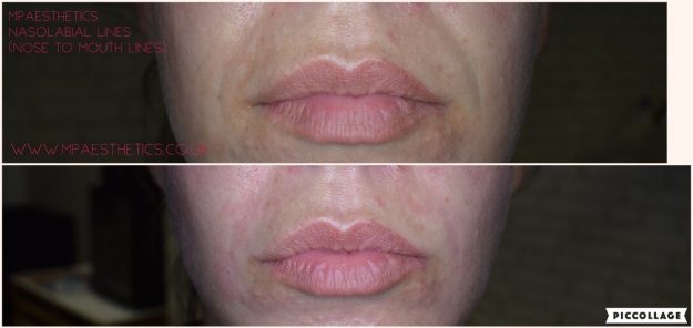 Cosmetic Lip Surgery in Newton Abbot