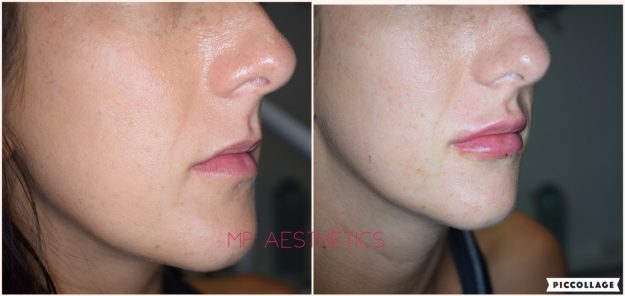 Cosmetic Lips in South Devon