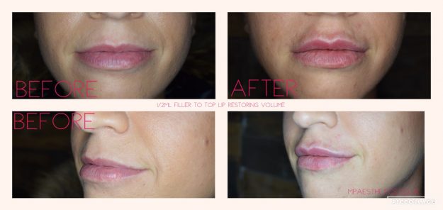 Lip Fillers in Newton Abbot