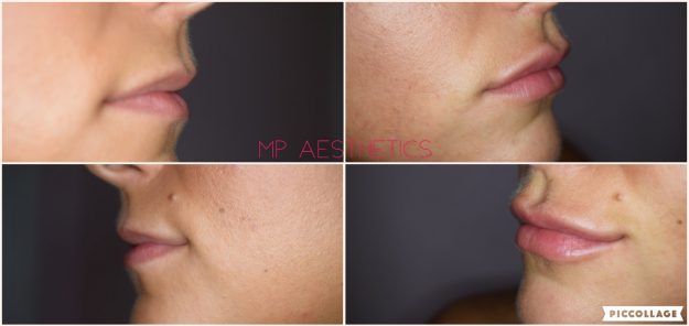 Lip Filler in South Devon